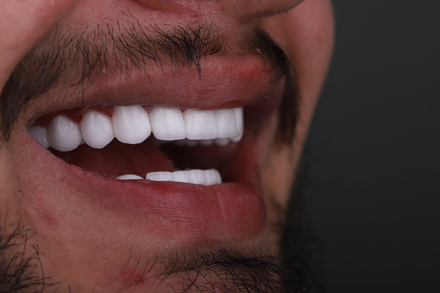 Turkey teeth Hollywood smile – Achieve a perfect, bright, and symmetrical smile