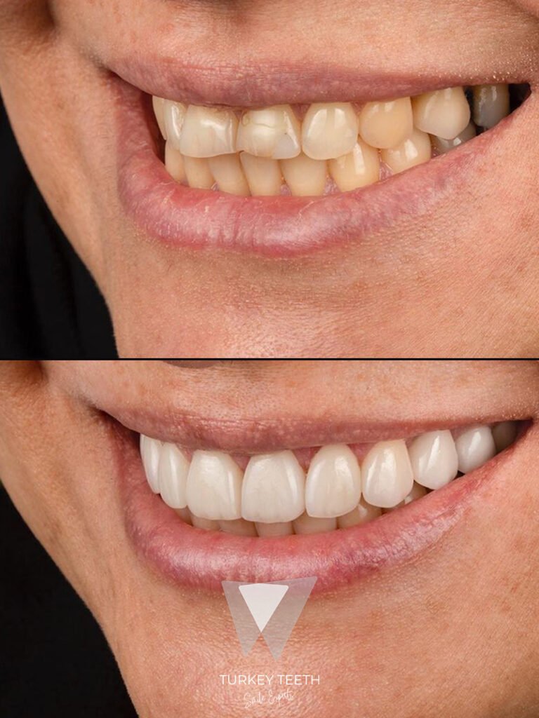 قبل وبعد تجميل الابتسامة في تركيا، يوضح التغيير الطبيعي في الأسنان الأمامية