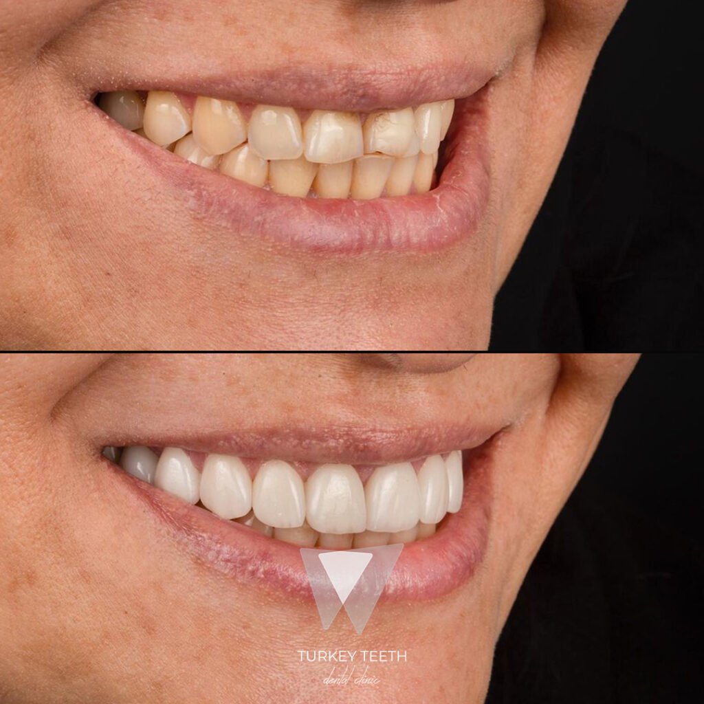صورة قبل وبعد من الأمام لتجميل الابتسامة في تركيا، تُظهر التحسين الجمالي الطبيعي باللون الأبيض