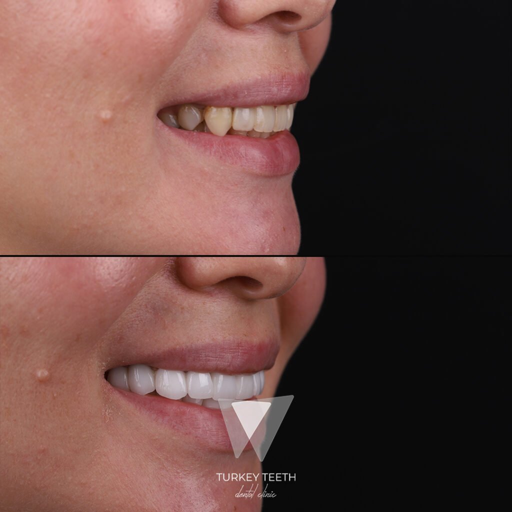 صورة قبل وبعد لجانب الابتسامة بعد علاج تجميل الابتسامة في تركيا، تُظهر تحويل كامل للقوس العلوي
