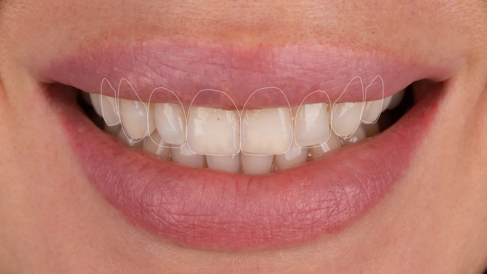 تخطيط رقمي لتصميم الابتسامة يعرض شكل الأسنان ومحاذاة الابتسامة لتجميل الابتسامة في تركيا
