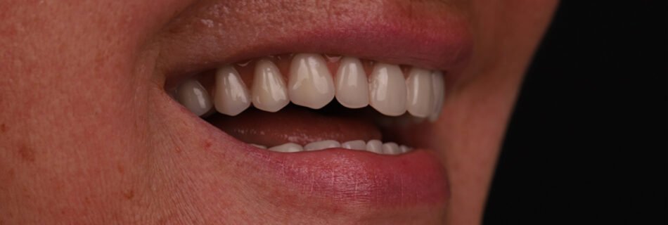 المنظر الجانبي النهائي للابتسامة بعد زرعات All-on-4 في تركيا