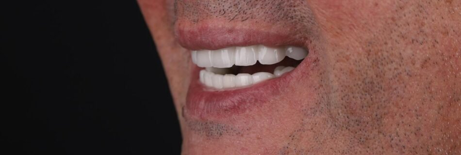 الابتسامة النهائية بعد زراعة الأسنان All-on-6 في حالة فقدان كامل للأسنان