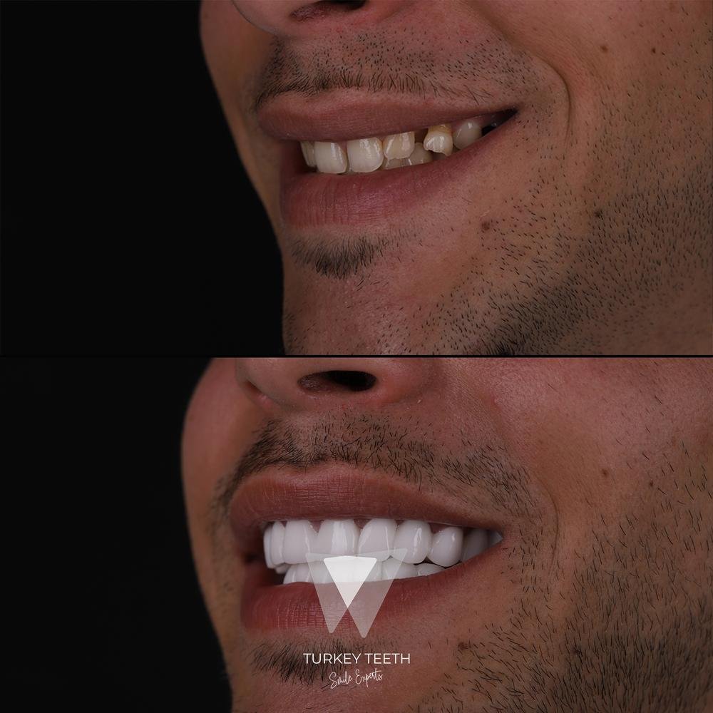 منظر أمامي قبل وبعد إعادة تصميم الابتسامة لمريض بأسنان مكسورة