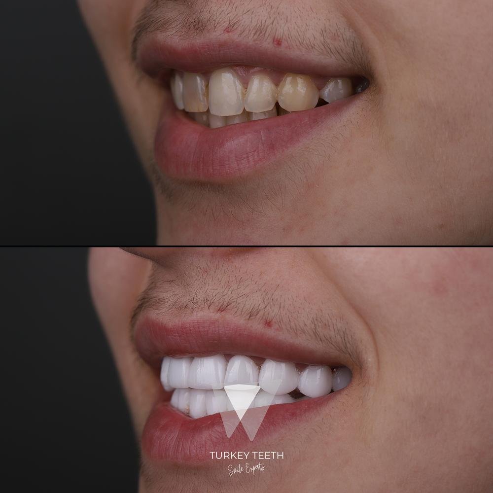 قبل وبعد إعادة تصميم الابتسامة لعيوب المينا – حالة في تركيا