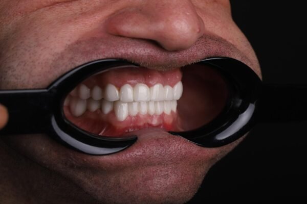الابتسامة النهائية بعد ترميم كامل للفم باستخدام الأسنان الثابتة في كوادرو دنتال