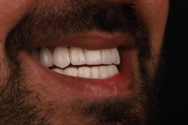 النتيجة النهائية للابتسامة بعد إعادة تصميم ابتسامة هوليوود باستخدام قشور الفينير لمريض في كوادرو دنتال