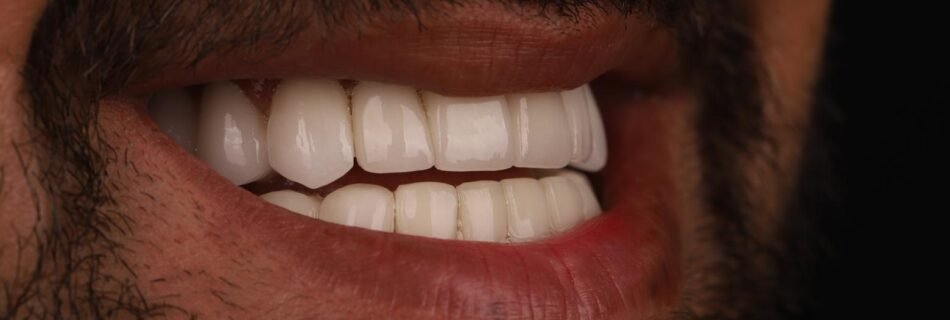 النتيجة النهائية للابتسامة بعد إعادة تصميم ابتسامة هوليوود باستخدام قشور الفينير لمريض في كوادرو دنتال