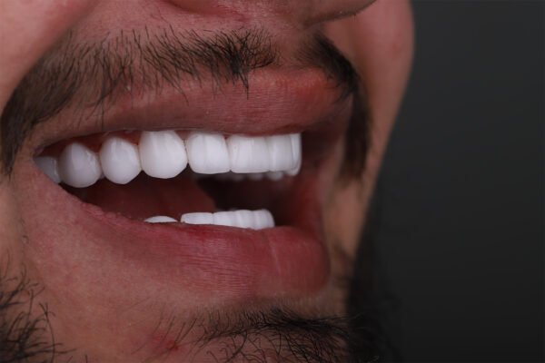 المنظر الجانبي لنتيجة ابتسامة هوليوود بعد العلاج التجميلي للأسنان في تركيا