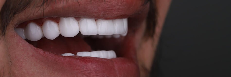 المنظر الجانبي لنتيجة ابتسامة هوليوود بعد العلاج التجميلي للأسنان في تركيا