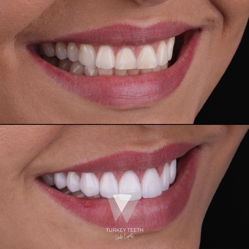 مقارنة قبل وبعد لإعادة تصميم الابتسامة باستخدام قشور الفينير اللّامينيتي