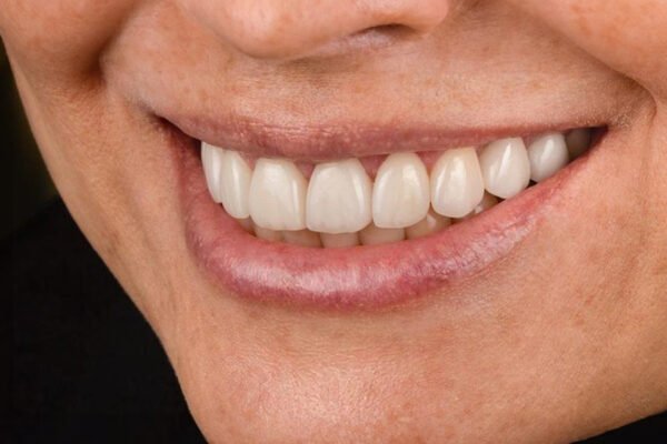 النتيجة النهائية للابتسامة لمريضة بعد علاج قشور الفينير اللّامينيتي