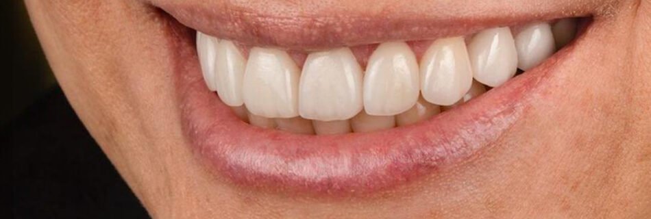 النتيجة النهائية للابتسامة لمريضة بعد علاج قشور الفينير اللّامينيتي