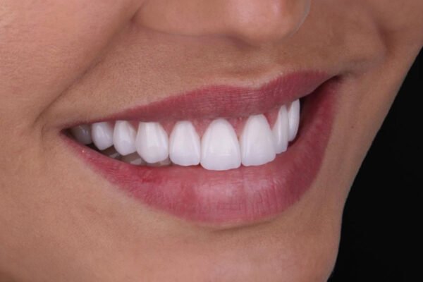 النتيجة النهائية بعد قشور الفينير اللّامينيتي تظهر ابتسامة طبيعية ومشرقة