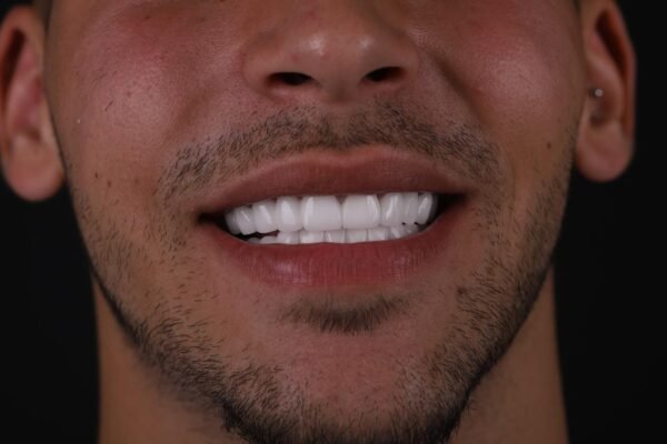 منظر أمامي للنتيجة النهائية لإعادة تصميم الابتسامة لعلاج الأسنان المكسورة في تركيا