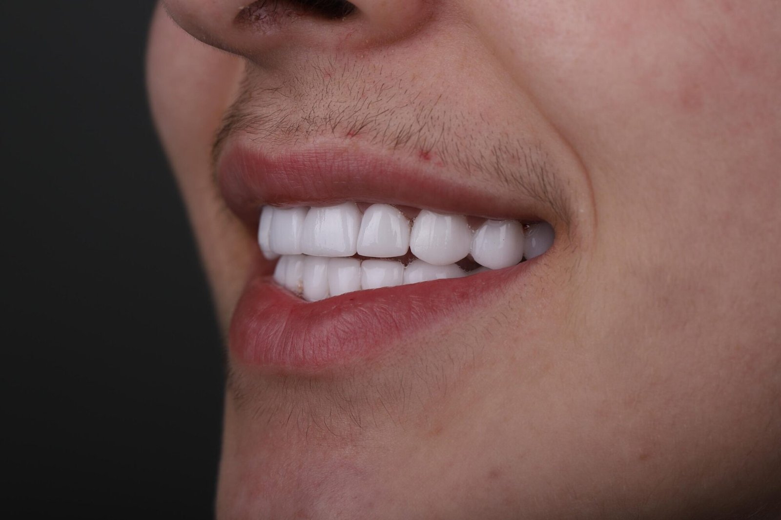 النتيجة النهائية من الجانب بعد إعادة تصميم الابتسامة لتصحيح عيوب المينا
