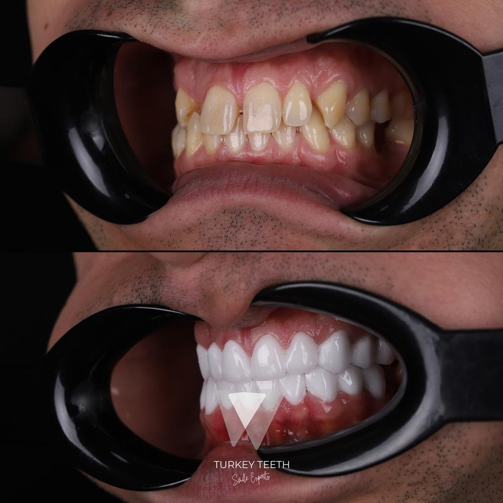 قبل وبعد – منظر جانبي أيمن لإعادة تصميم ابتسامة بالقشور في تركيا