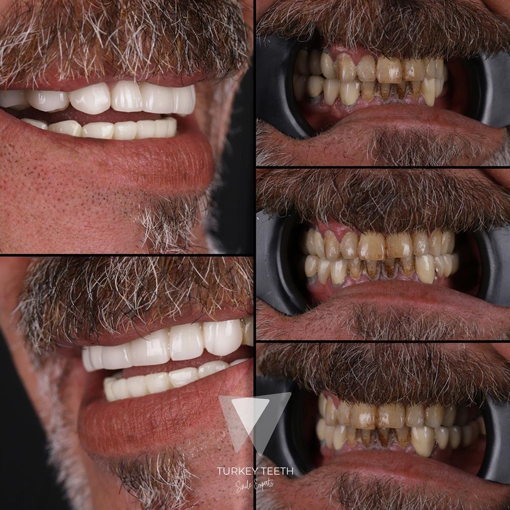 صور قبل وبعد علاج تيجان الزركونيوم لترميم كامل للفم في بيناكل دينتال