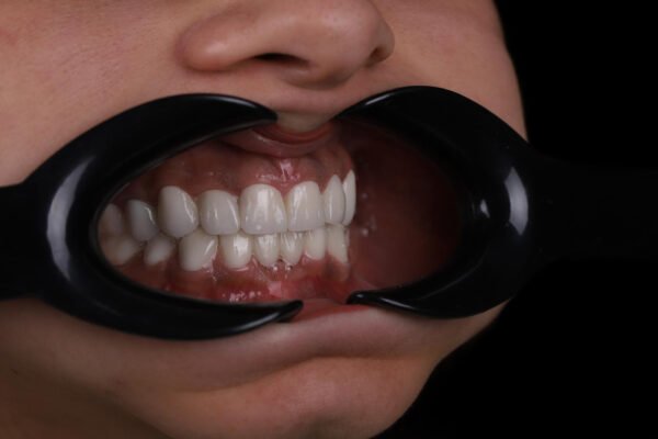 الابتسامة النهائية بعد إعادة تصميم الابتسامة باستخدام تيجان الزركونيوم في كوادرو دنتال