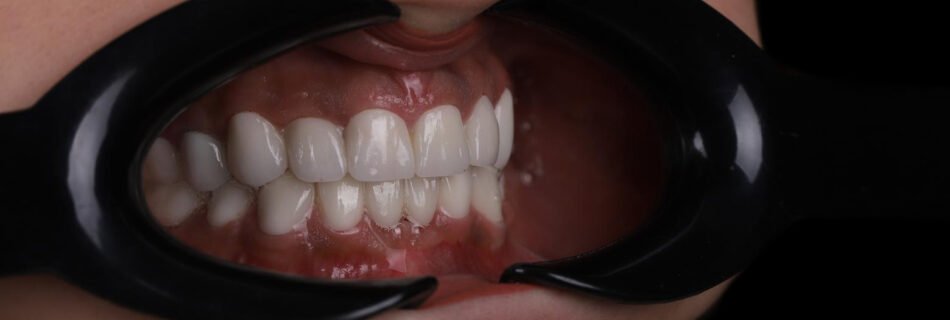 الابتسامة النهائية بعد إعادة تصميم الابتسامة باستخدام تيجان الزركونيوم في كوادرو دنتال