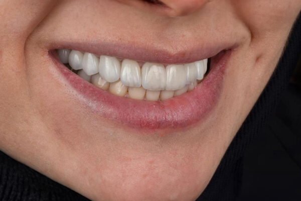 النتيجة النهائية للابتسامة بعد إعادة تصميم الابتسامة كاملة باستخدام تيجان الزركونيوم لمريضة