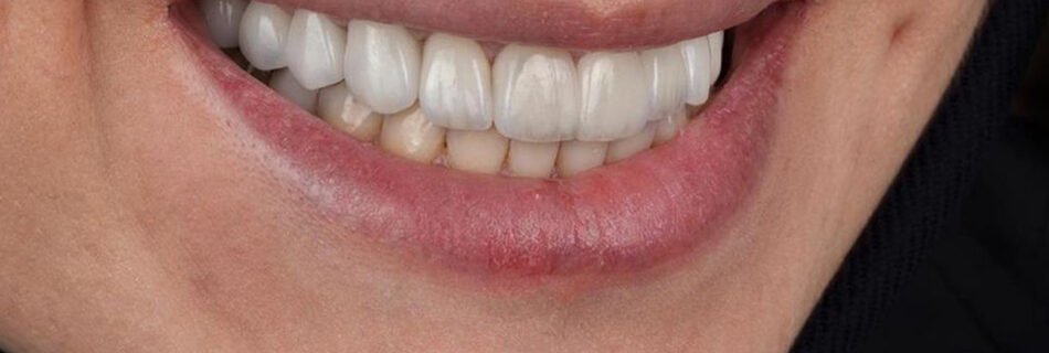 النتيجة النهائية للابتسامة بعد إعادة تصميم الابتسامة كاملة باستخدام تيجان الزركونيوم لمريضة
