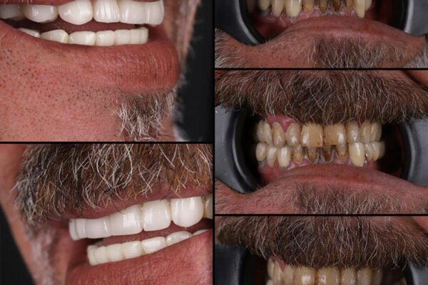 النتيجة النهائية للابتسامة بعد علاج كامل للفم باستخدام تيجان الزركونيوم لمريض في كوادرو دنتال