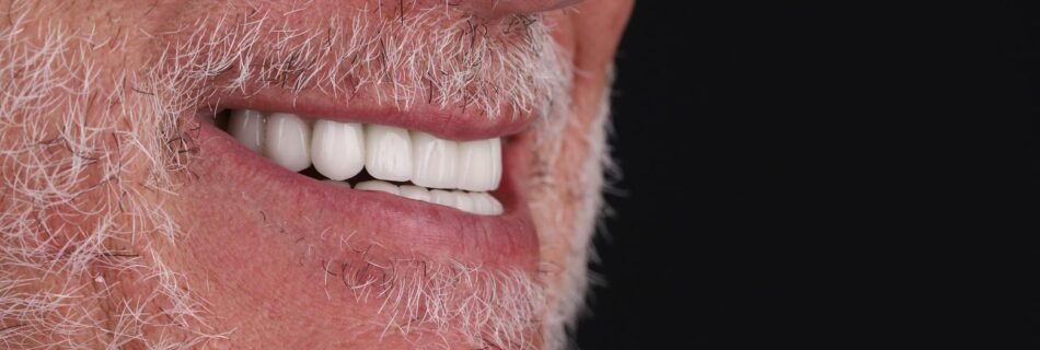 النتيجة النهائية للابتسامة في مريض مسن بعد علاج تيجان الزركونيوم